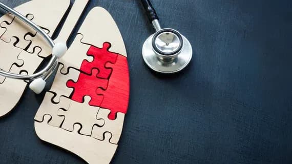 UC Irvine Implements AI to Find Lung Cancer Screening Candidates