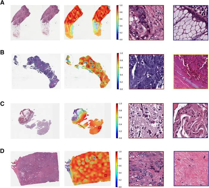 AI Accurately Analyzes Histopathology Slides for Genes and Biomarkers in 32 Cancers