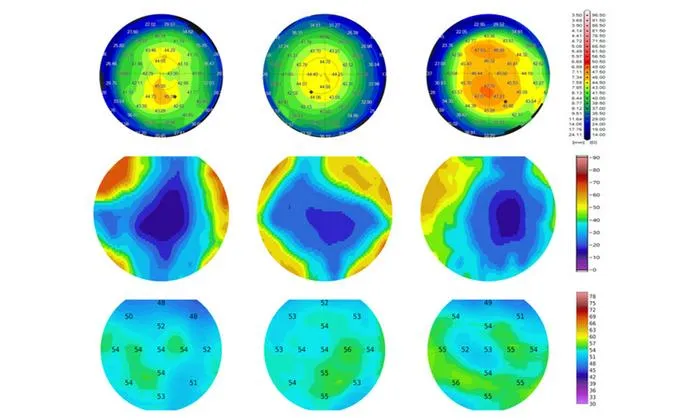 AI and PS-OCT Enhance Early Keratoconus Detection