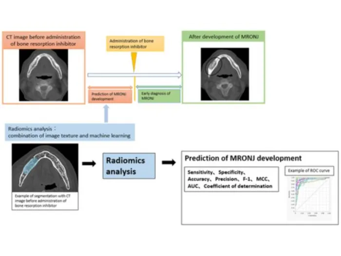AI and Radiomics from CT Scans Predict MRONJ Risk Pre-Treatment
