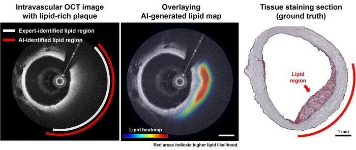 AI-Driven OCT Accurately Detects Lipid Plaques in Arteries
