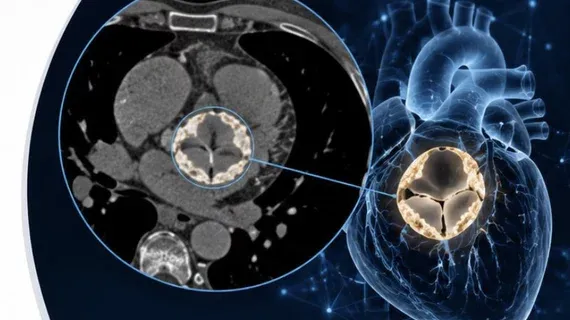 AI Finds Hidden Aortic Stenosis in Routine Chest CTs