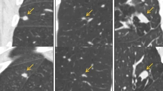 🔍 AI halves false positives in multicenter lung cancer CT screening
