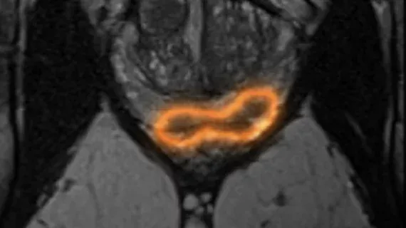 AI Matches Radiologists in Prostate MRI Cancer Detection in Global Study