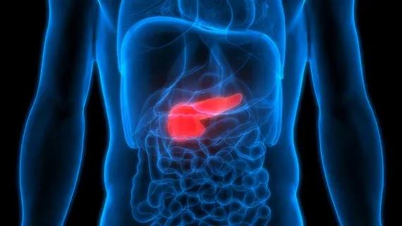 AI Model Outperforms Radiologists in Early Pancreatic Cancer Detection