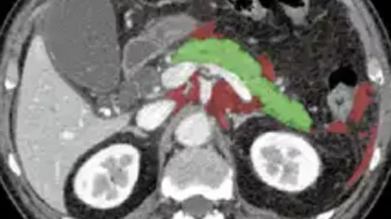 AI Model Predicts Organ Failure in Acute Pancreatitis via CT Imaging