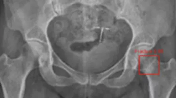 AI Model Surpasses Radiologists in Detecting Subtle Hip Fractures