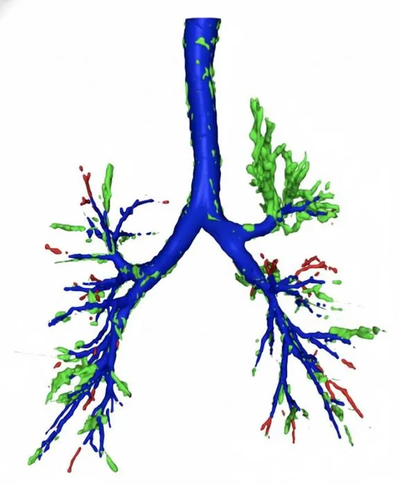 AI Outperforms Radiologists in Detecting Hidden Airway Objects on Chest CT