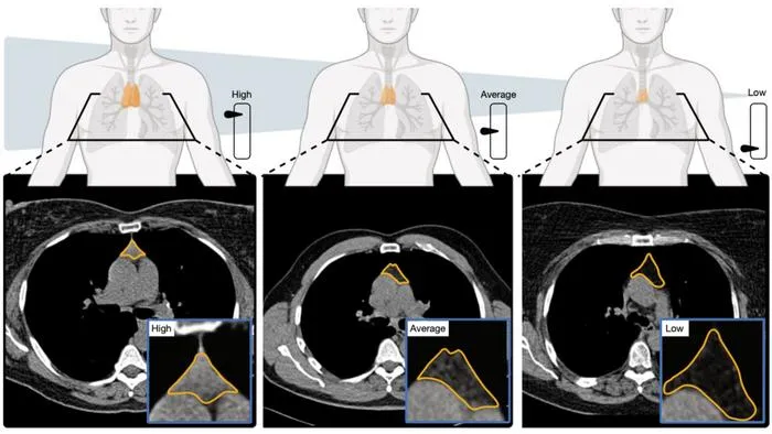 🧬 AI Thymic Scoring on CT Tied to Survival and Immunotherapy Benefit