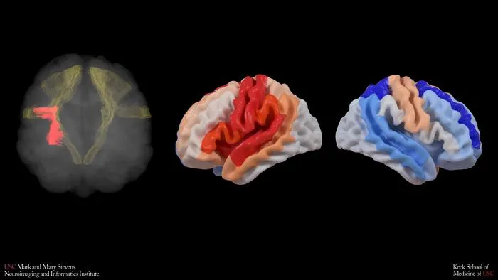 AI-Powered MRI Reveals Brain Rewiring in Stroke Recovery