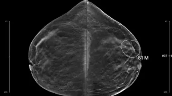 AI Tool Detects Up to One-Third of Missed Interval Breast Cancers