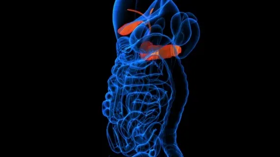 AI Tool Outperforms Radiologists in Pancreatic Cancer Detection