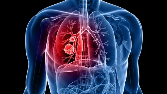 Deep Learning Enhances Prediction of Incidental Lung Nodule Malignancy