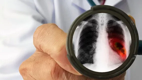 FDA Clears Median's Eyonis AI for CT Lung Cancer Screening