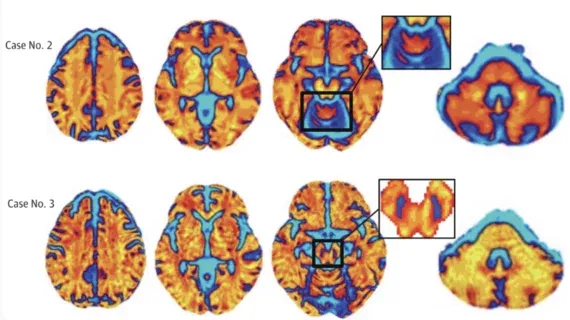 MRI AI for Parkinsonian Syndrome Gains FDA De Novo Clearance