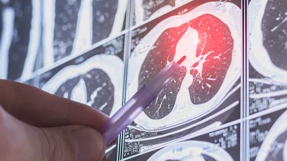 🫁 Prospective RCT: AI Significantly Boosts Lung Nodule Detection