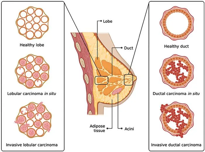 Review Highlights AI's Impact on Breast Cancer Imaging and Recurrence Prediction