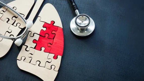 UC Irvine Implements AI to Find Lung Cancer Screening Candidates