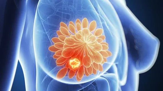 Vara's AI Gains World's First Approval for Radiologist-Free Mammogram Triage