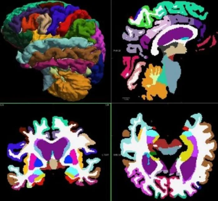 WPI Team Achieves 93% Accuracy in MRI-AI Alzheimer's Prediction
