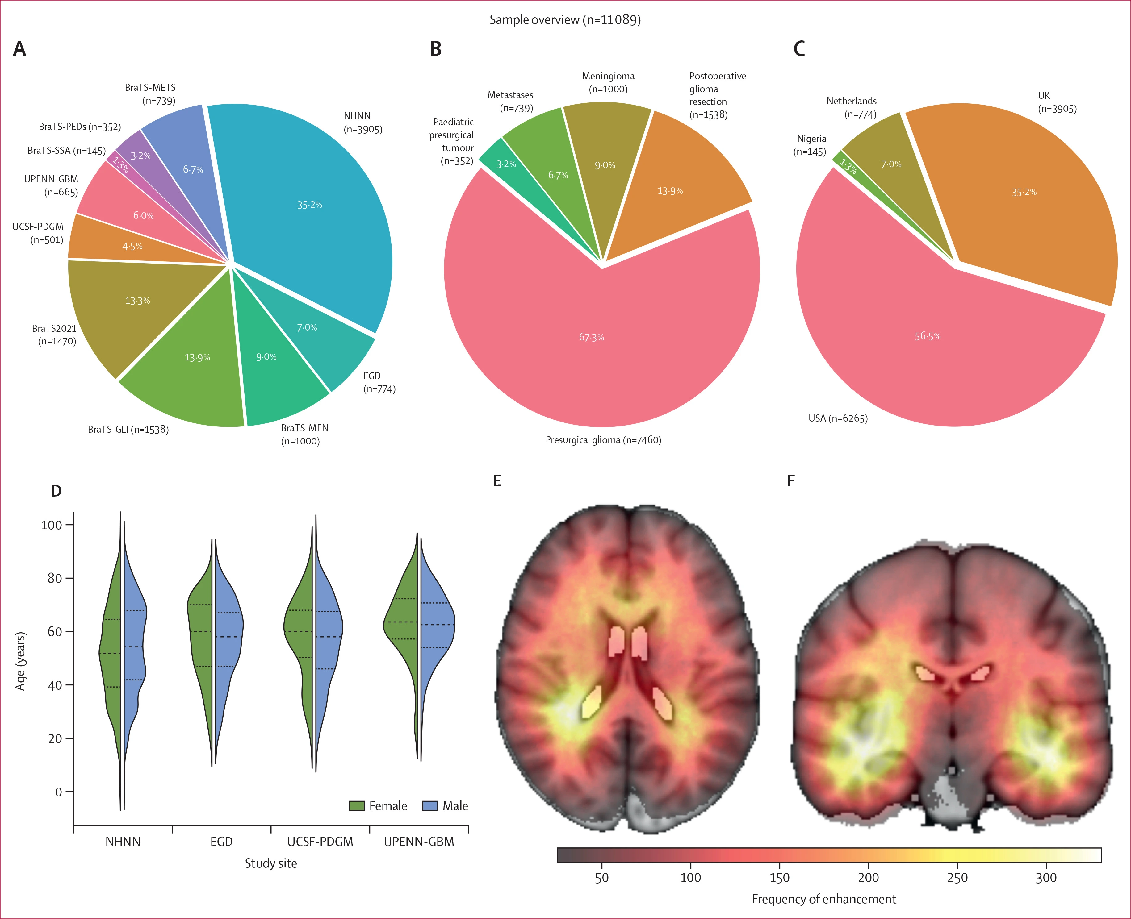 11089 MRIs train AI to flag tumor enhancement