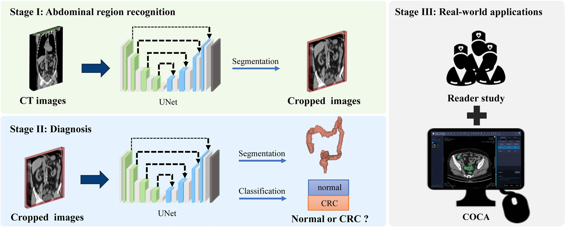 AI flags CRC on routine CT with 99.8% specificity