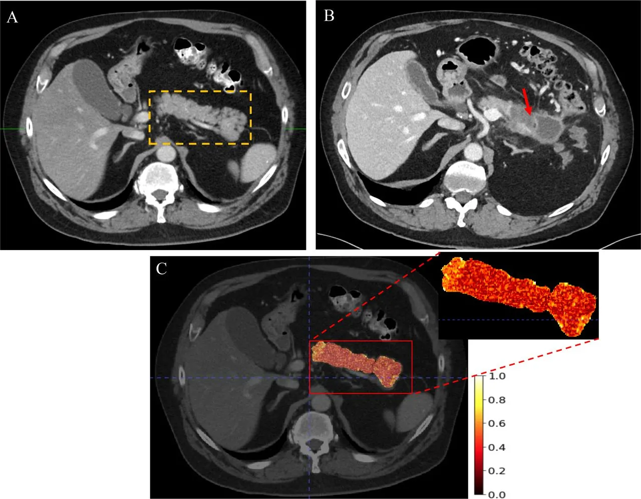 CT AI flagged occult pancreatic cancer 475 days early